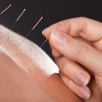 Prøv akupunktur i dag og oplev resultaterne!