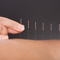 Moderne akupunktur mod smerter hos AcuNova