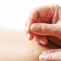 Alternativ behandling med AcuNova akupunktur